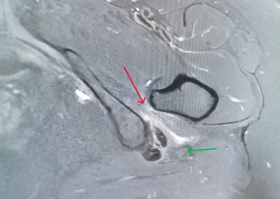 Edema muscular cuadrado femoral (flecha roja) . Nervio ciático (Flecha verde) drjordijimenez