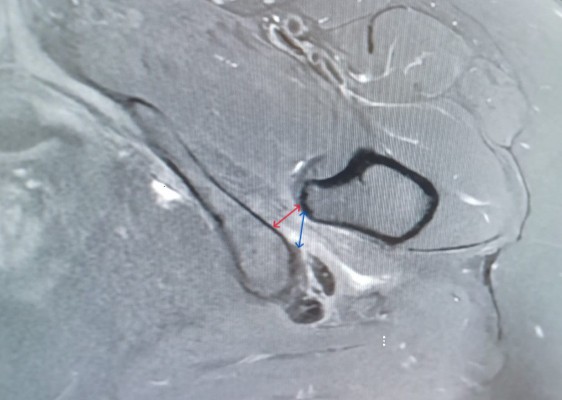   mediciones de distancia isquiofemoral (línea roja)y cuadrado femoral(línea azul) drjordijimenez