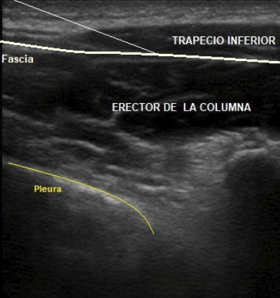 acceso aguja espacio interfascial dr. jordi jimenez