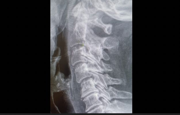 Artrosis cervical drjordijimenez