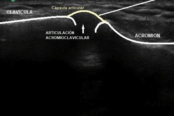 infiltración ecoguiada acromioclavicular dr. jordi jiménez