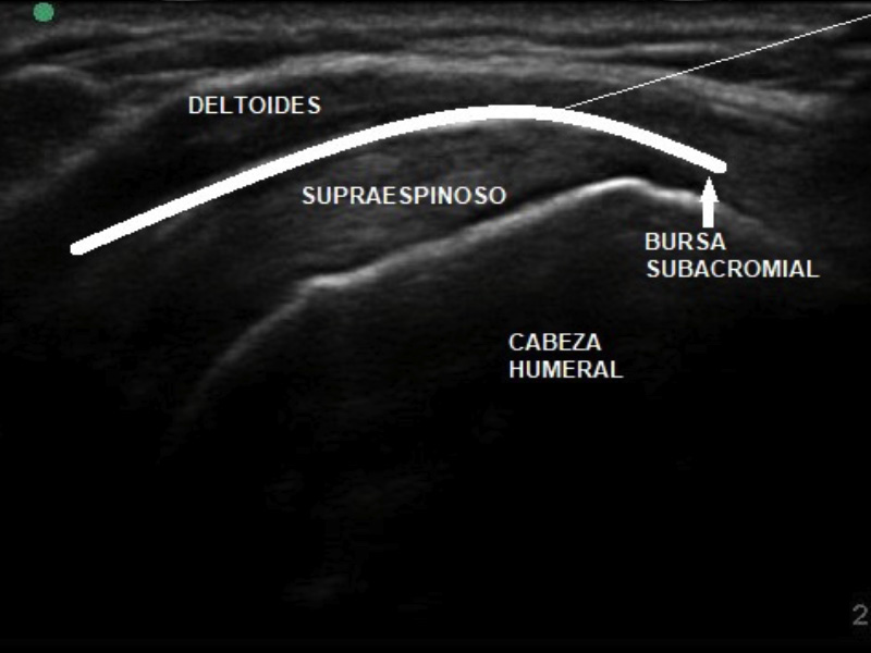 infiltración ecoguiada bursa subacromial del hombro