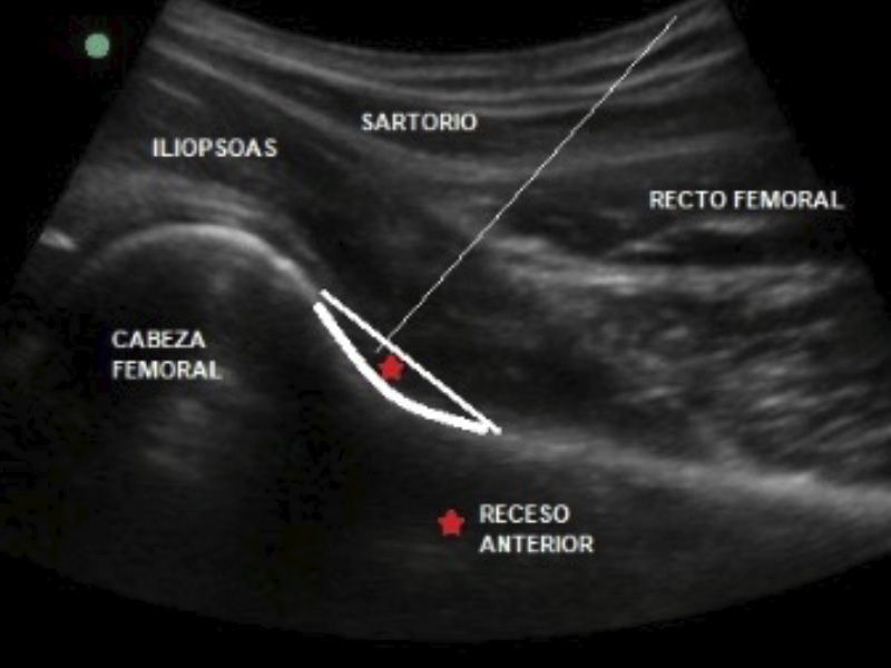 infiltración ecoguiada cadera dr. jordi jiménez