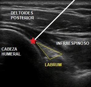 infiltracion ecoguiada glenohumeral dr. jordi jimenez