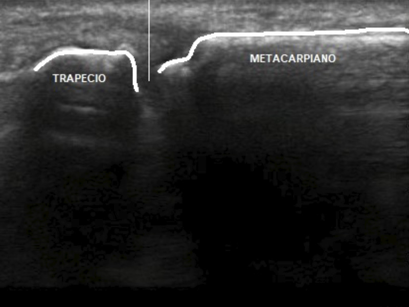 infiltracion ecoguiada rizartrosis dr. jordi jimenez