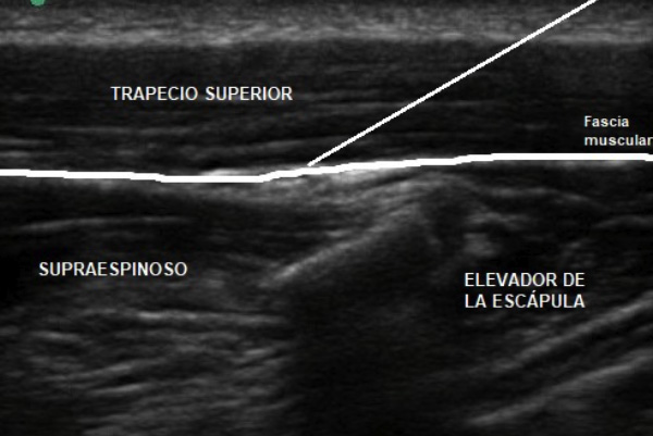infiltración ecoguiada interfascial trapecio superior y elevador de escápula