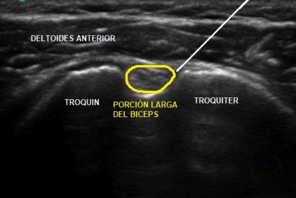 infiltración ecoguiada porción larga del biceps dr. jordi jimenez
