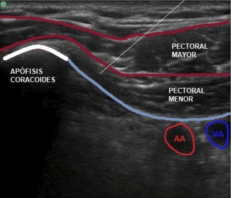 infiltracion sindrome de pectoral menor