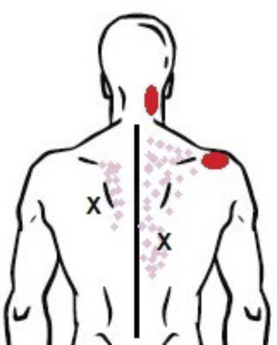 puntos gatillo y dolor referido del músculo trapecio inferior dr. jordi jimenez