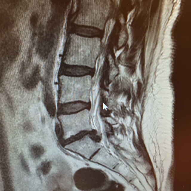 traumatologiaenmallorca-hernia-discal-extruida-izquierda-2