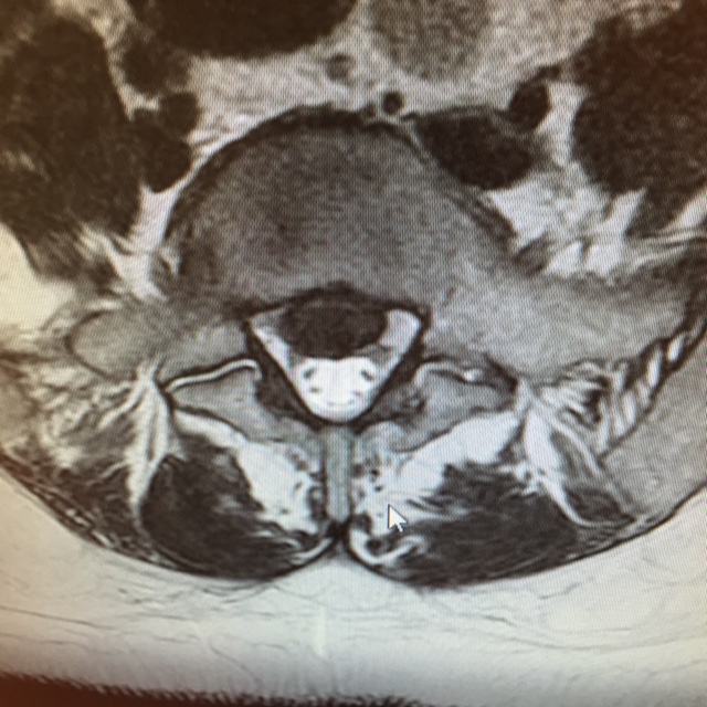 traumatologiaenmallorca-hernia-discal-extruida-izquierda-1